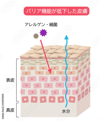 バリア機能が低い皮膚　肌細胞と断面図