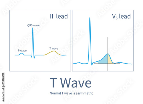 .The T wave is the ventricular repolarization wave. The normal T wave is asymmetric: the ascending branch is slow and the descending branch is steep. photo