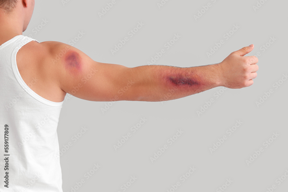 Man with bruises on arm against light background Man with bruises on arm against light background