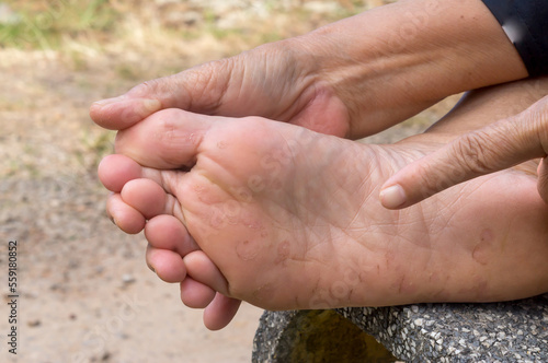 Woman hand pointing at foot sore caused by Athlete's foot, Patient suffering from severe foot skin disease, Close up photo of foot disease © nathamag11