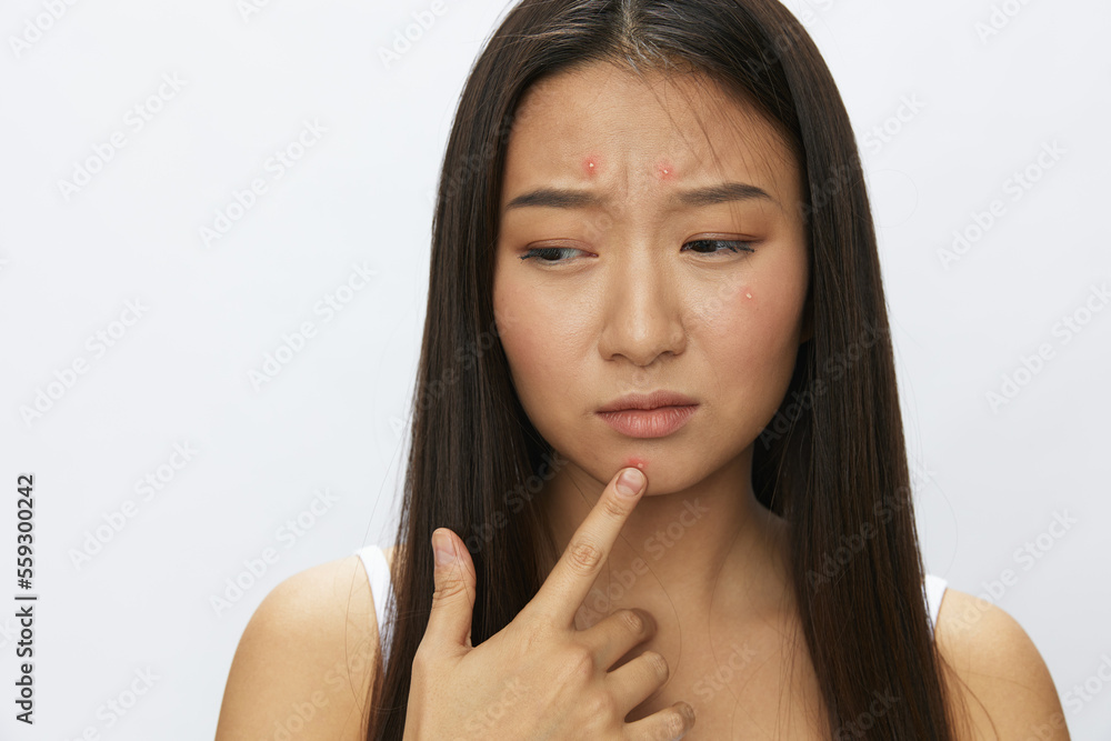 Asian woman facial skin problems, acne and inflammation, red rashes and allergies, chicken pox, sadness from rashes. Facial skin care concept for diseases and nerves Asian woman facial skin problems, acne and inflammation, red rashes and allergies, chicken pox, sadness from rashes. Facial skin care concept for diseases and nerves