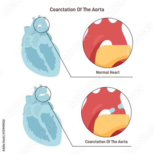 Aortic coarctation. Birth defect in which a part of the aorta narrowing photo