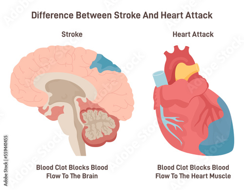 Stroke and heart attack. Plaque develops on the inside of the blood vessel