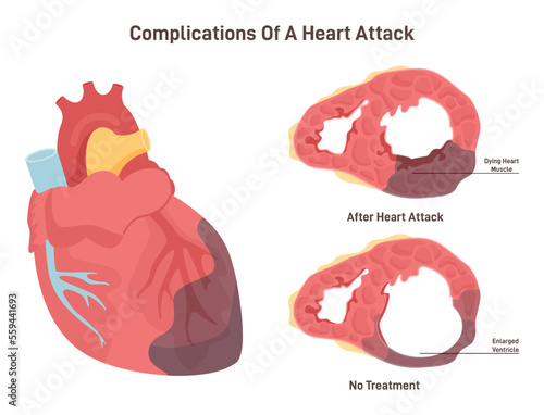 Heart attack complications. Heart wall thining and ventricle enlargening