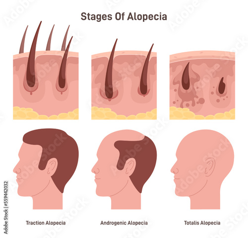 Hair loss stages. Male alopecia or balding process. Man head side view