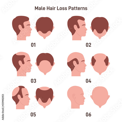 Male hair loss pattern set. Hair loss, balding process. Male alopecia.