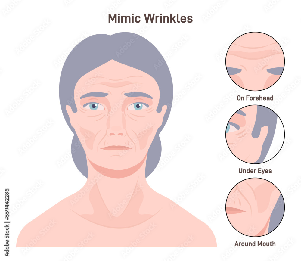 Mimic wrinkles. Age-related skin changes. Aging process, forehead Mimic wrinkles. Age-related skin changes. Aging process, forehead