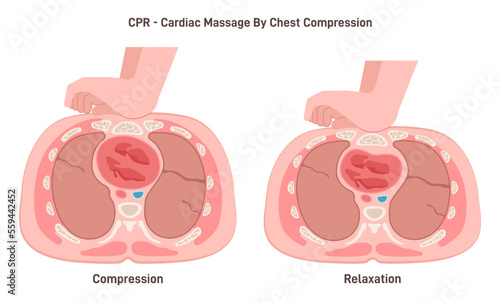 Heart massage or first aid cardiopulmonary resuscitation, chest compression