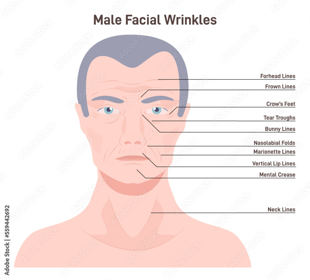 Mimic wrinkles. Age-related skin changes. Aging process, forehead Mimic wrinkles. Age-related skin changes. Aging process, forehead