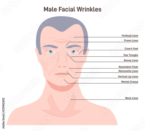 Mimic wrinkles. Age-related skin changes. Aging process, forehead