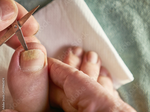 The nail cavity is cleaned with scissors. Treatment of fungal nail diseases.