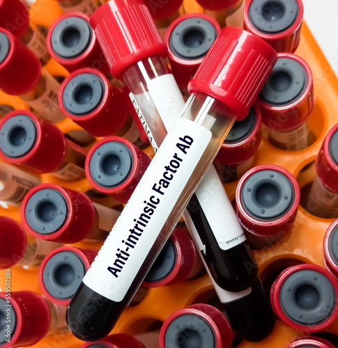 Intrinsic Factor Ab test, to confirm a diagnosis of pernicious anemia. Antiparietal Cell Antibody.