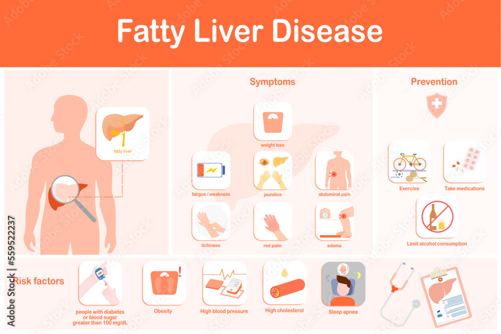 Vector illustration. Infographic of fatty liver disease. Symptoms, prevention and risk factors Vector illustration. Infographic of fatty liver disease. Symptoms, prevention and risk factors