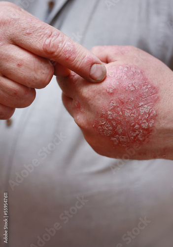 Close up of male showing hands with cracked, hard, horny, flaky skin. Dermatological problems of psoriasis, allergy, eczema. Hand stains, rash, dry skin. The concept of chronic disease treatment.