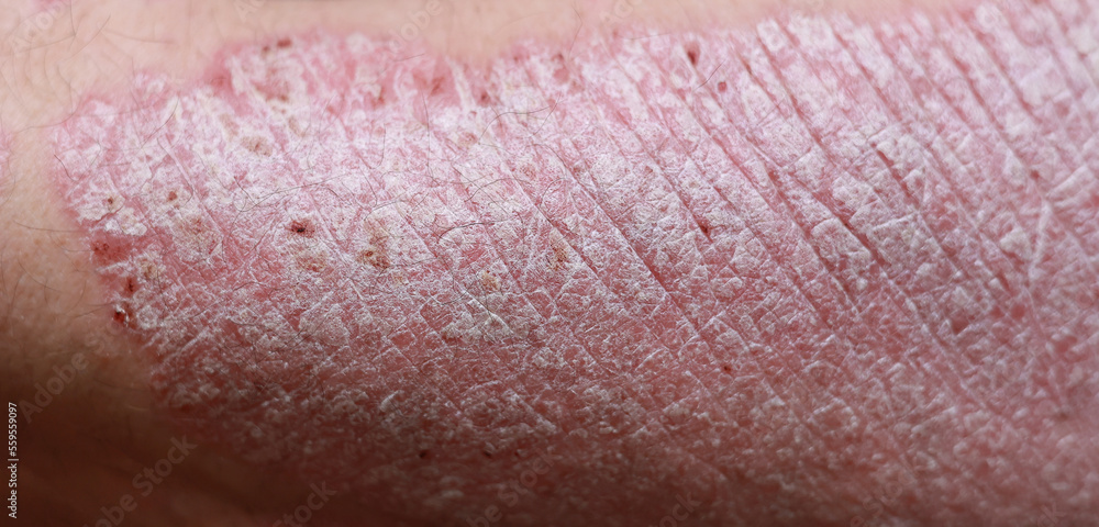 Fototapeta premium Close up, macro of psoriasis skin, autoimmune disease that affects the skin cause skin inflammation red and scaly. Skin allergy with severe symptoms. Dermatitis rash and ugly eczema.