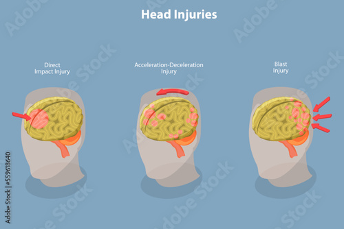 3D Isometric Flat Vector Conceptual Illustration of Brain Injuries, Head Trauma Scheme