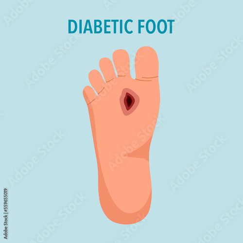 Diabetic foot syndrome concept vector illustration.
