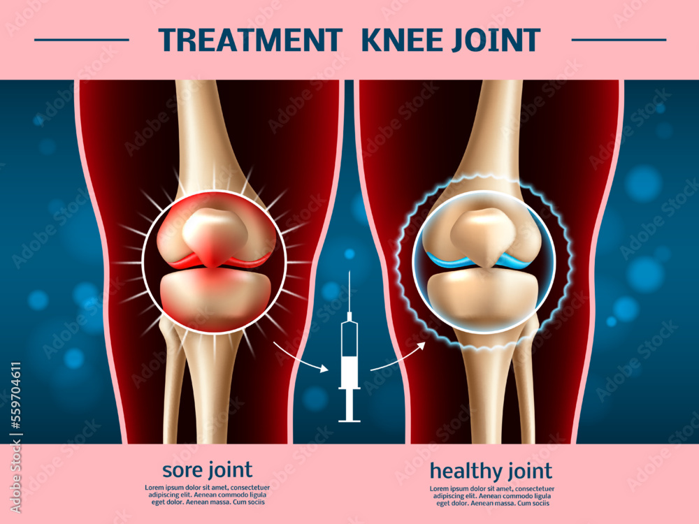 Realistic knee joints. Osteoarthritis treatment, anti inflammatory
