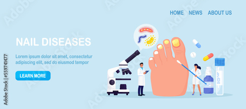 Onychomycosis. Feet with nail disease. Fungal nails infection. Doctors exam, treat nails psoriasis. Doctor dermatologist analyzes psoriatic toenails. Inflammation of toenail skin. Medical treatment