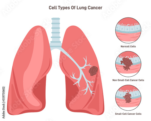 Lung cancer cell types. Pathological malignant cells or tumor located