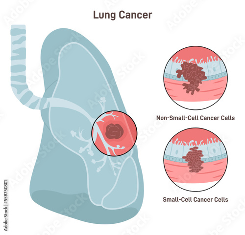 Bronchial cancer. Pathological malignant cells or tumor located