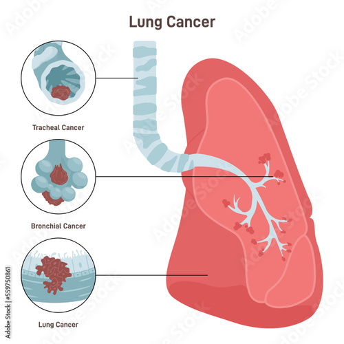 Bronchial cancer. Pathological malignant cells or tumor located