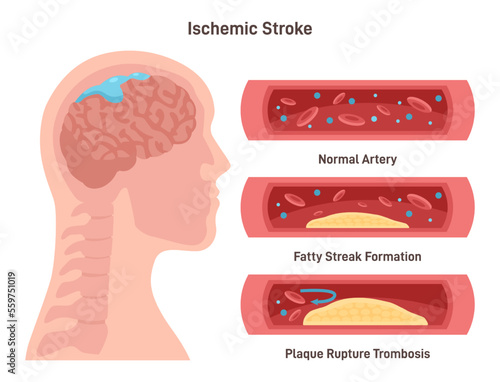 Ischemic brain stroke. Damaged human brain, blood supply interrupted