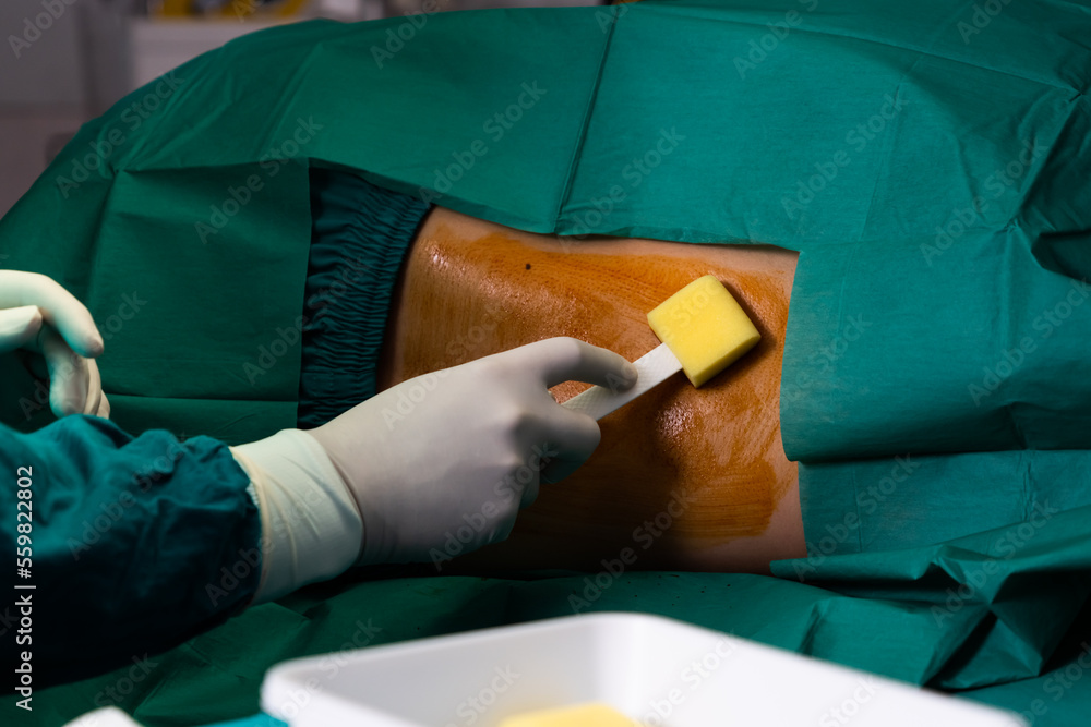 Foto de Doctor or surgeon apply betadine to the patient for anesthesia