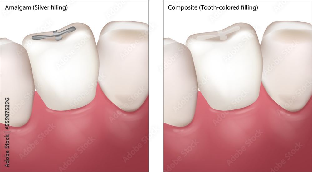 Dental Filling Procedure. Amalgam Silver filling and Composite Tooth