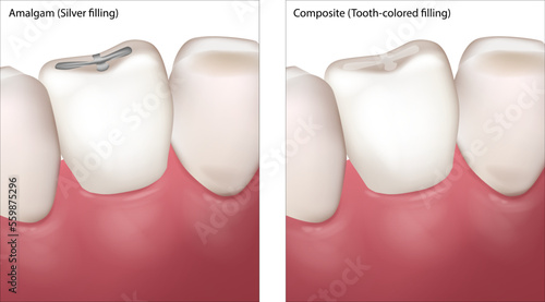 Dental Filling Procedure. Amalgam Silver filling and Composite Tooth colored filling.
