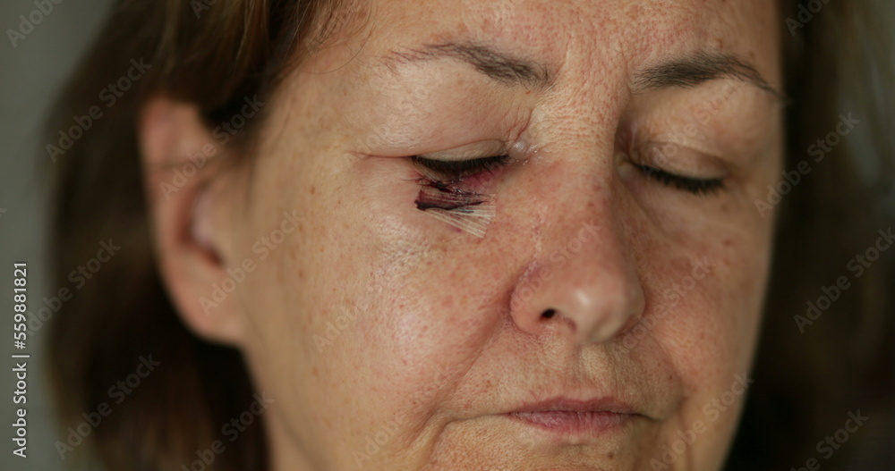 Older woman with healing scar after surgery Older woman with healing scar after surgery