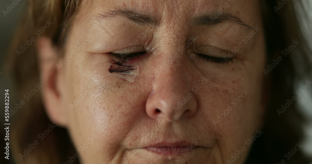 Close-up of older woman bruised, scarred face looking to camera Close-up of older woman bruised, scarred face looking to camera