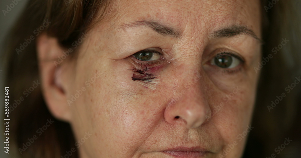 Close-up of older woman bruised, scarred face looking to camera Close-up of older woman bruised, scarred face looking to camera