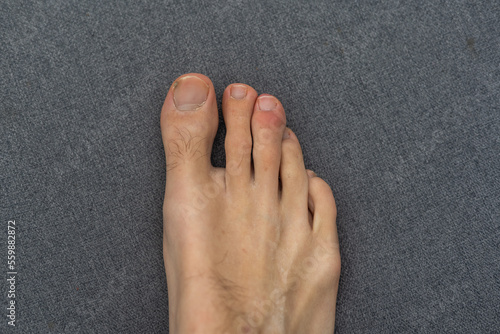 Tableau sur toile Young white male hairy foot with uncared toe nails