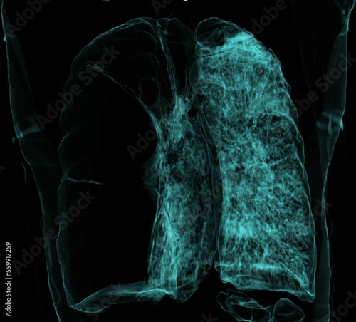 giant  bullae , chest ct scan