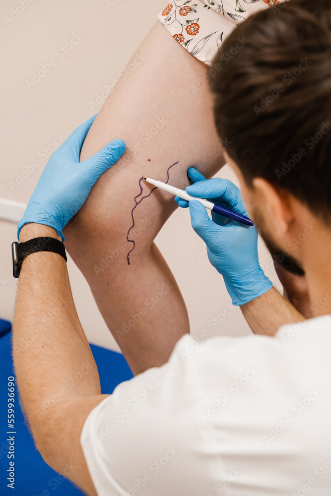 The phlebologist is marking legs before surgery to remove the veins. The vascular surgeon is marking leg veins. Vein markup. The phlebologist is marking legs before surgery to remove the veins. The vascular surgeon is marking leg veins. Vein markup.