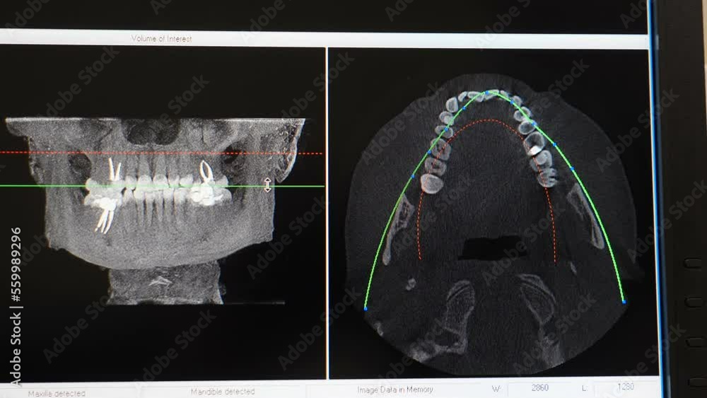 CT scan of patient with malocclusion, Jaw scanning, digital imprint, medical digital technology
