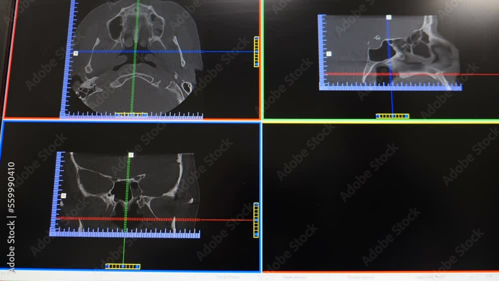 Panoramic dental xray. MRI scanning. Upper and lower jaw teeth. Closeup of CT scan. Jaw