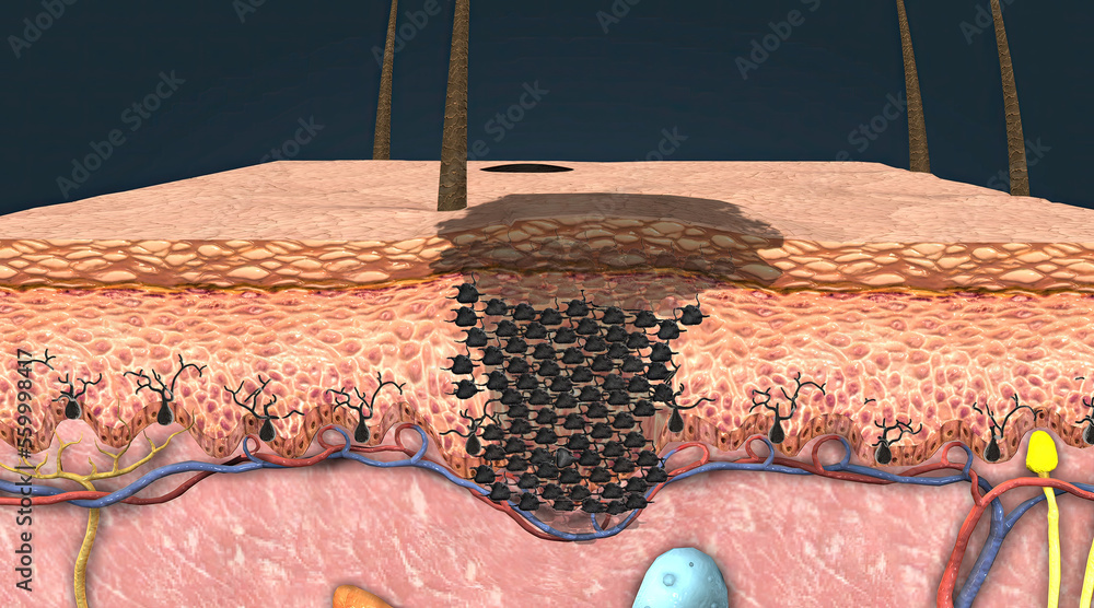 It is a skin tumor arising from melanocytes that give the skin its