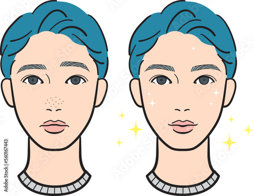 鼻の毛穴の黒ずみのある若い男性のビフォーアフター