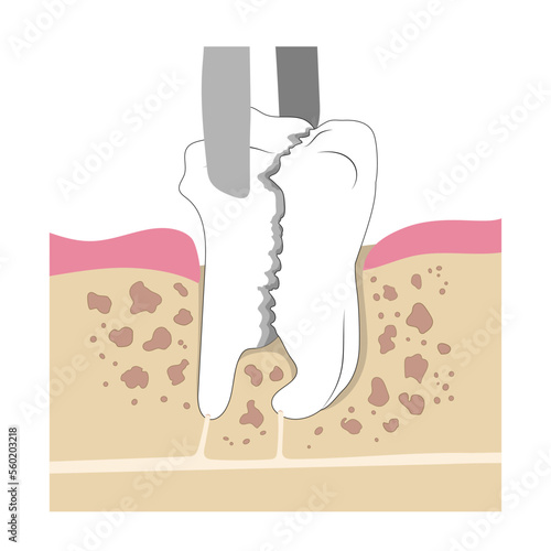 Removal of molar tooth crashed in the jaw. Surgical extraction of a broken tooth. Medical illustration in flat style.