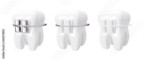 Tooth with dental braces isolated on transparent background 3d rendering