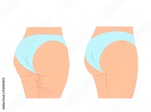 Vector of a woman with cellulite vs healthy skin.