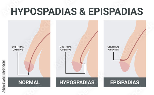 Hypospadias and Epispadias Medical Vector Illustration