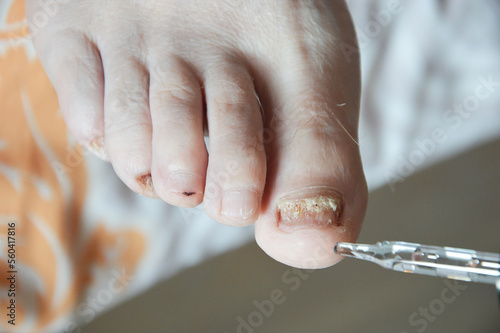 toenail fungus. human viral diseases. background for the design.