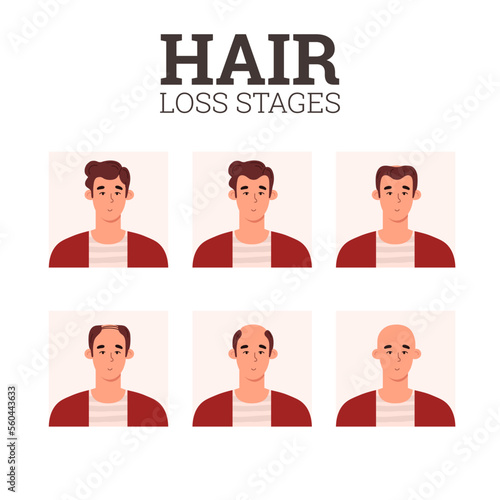 Hair loss stages, alopecia problem infographics - flat vector illustration on white background.