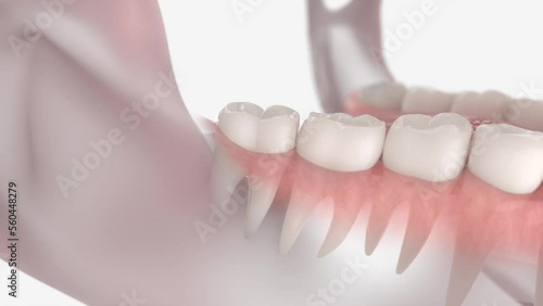 Wisdom tooth extraction followed by suturing