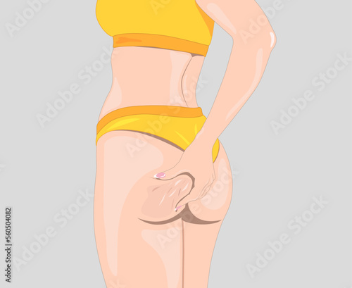The girl stretches the skin on her leg, shows fat deposits and cellulite. The concept of weight loss and healthy lifestyle.