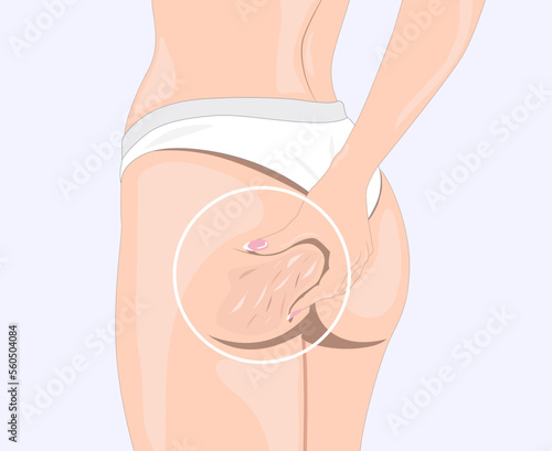 The girl stretches the skin on her leg, shows fat deposits and cellulite. The concept of weight loss and healthy lifestyle.