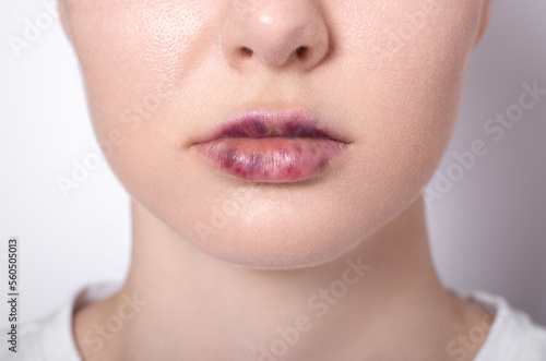 real women's bruised lips after lip augmentation injection of hyaluronic acid close-up, complications and hematomas after a beauty hyaluronan injection on female lips, contour lip plastic surgery